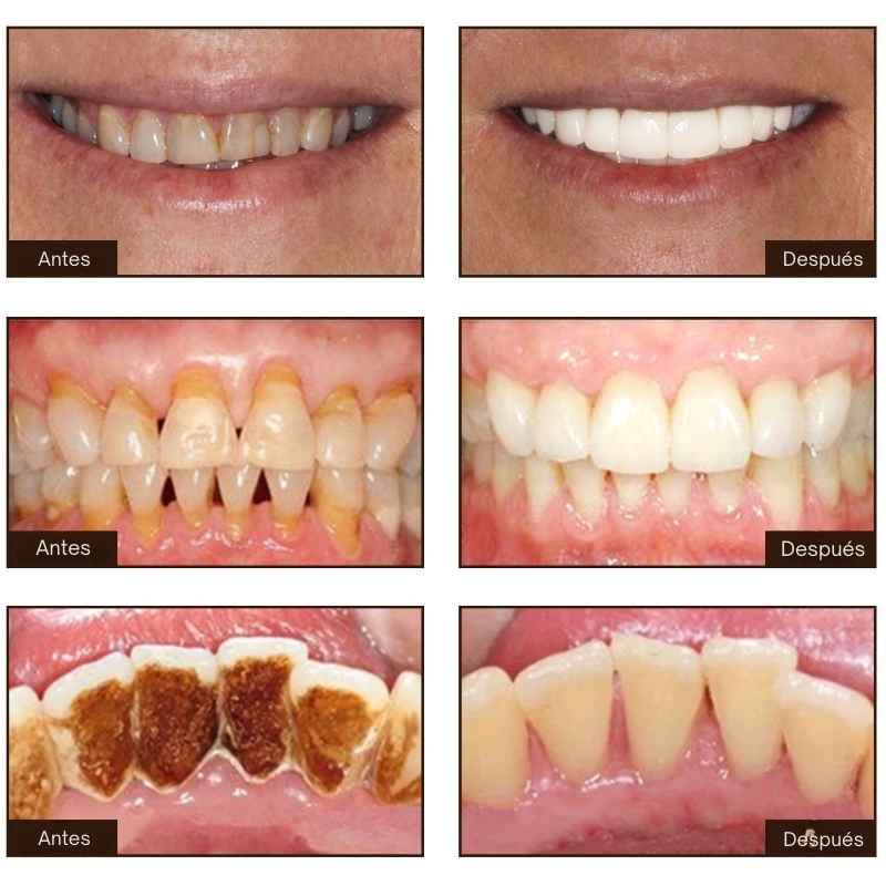 BodyAccel Con Niacinamida - Sonrie Seguido Sin Ocultar Tus Dientes